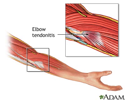Tendinitis